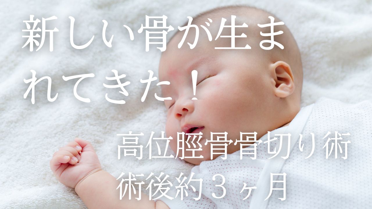 脛骨の骨切り日記 #19-新しい骨が出来てきた！